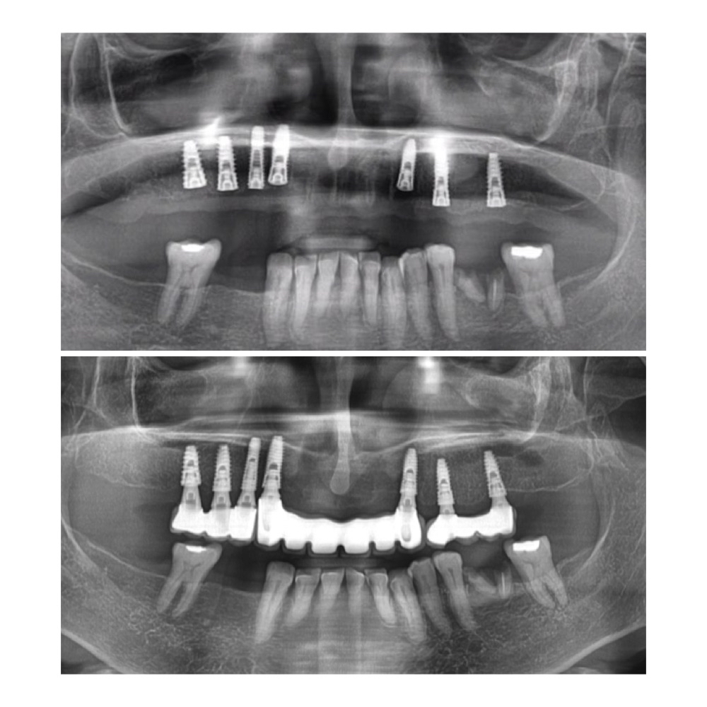 Dental Implants
